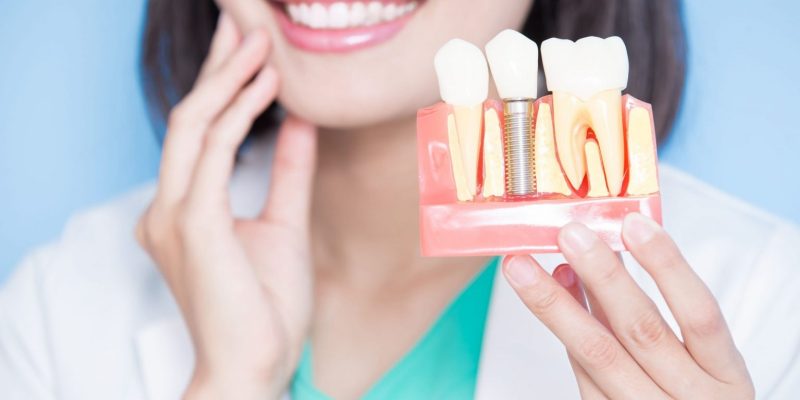 Dental Implants