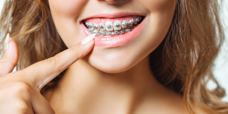 Orthodontic Treatment 1