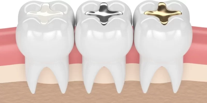 Teeth Coloured Dental Fillings