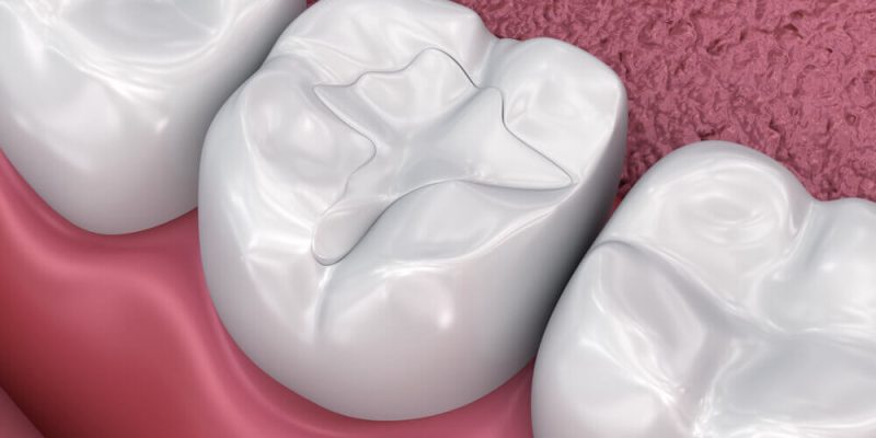 cosmetic fillings1