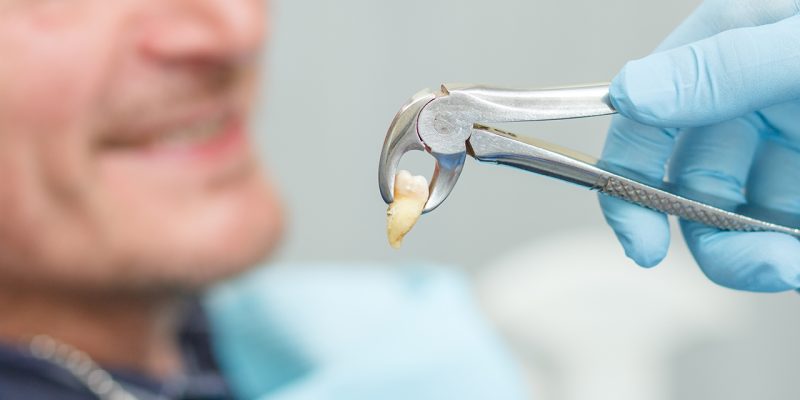 tooth-extraction